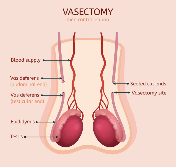 Can a vasectomy cause erectile dysfunction (ED)?