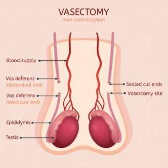 Can a vasectomy cause erectile dysfunction (ED)?