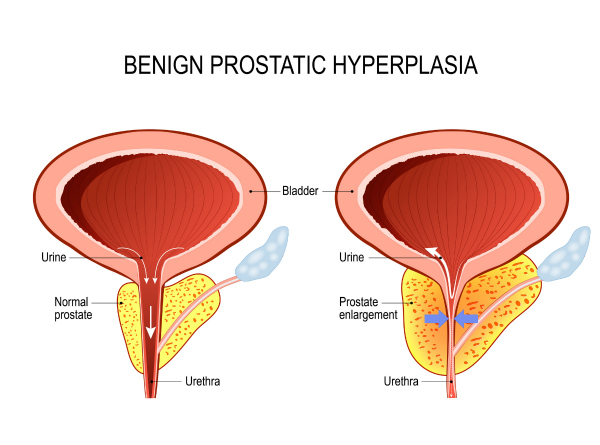What is benign prostatic hyperplasia (BPH)? How is it diagnosed?
