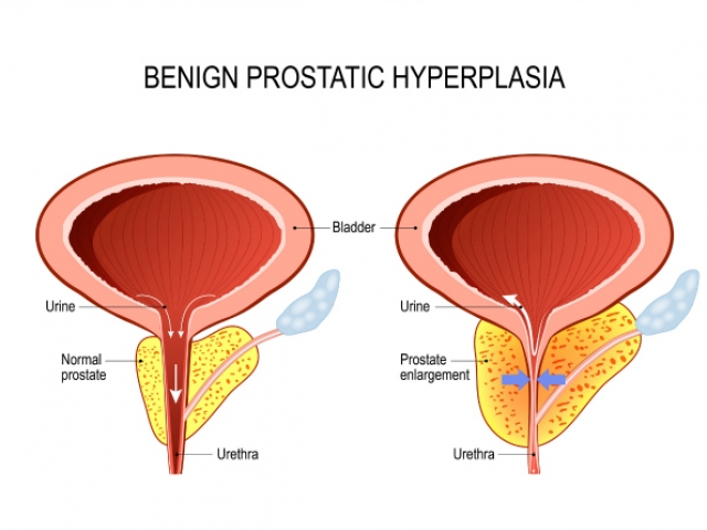 What is benign prostatic hyperplasia (BPH)? How is it diagnosed?