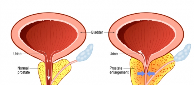 What is benign prostatic hyperplasia (BPH)? How is it diagnosed?