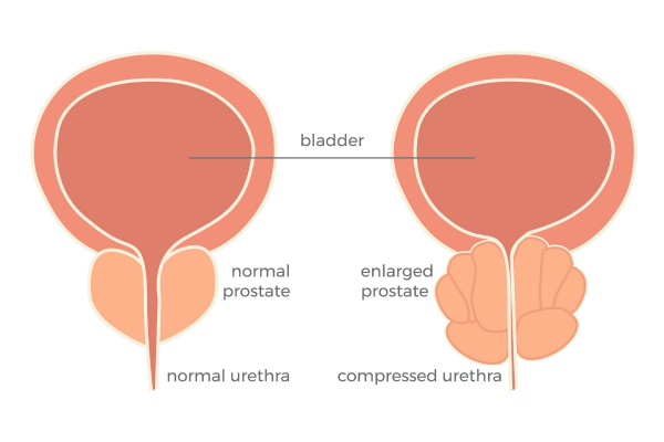 What are some nonsurgical treatments for an enlarged prostate (benign prostatic hyperplasia – BPH)?