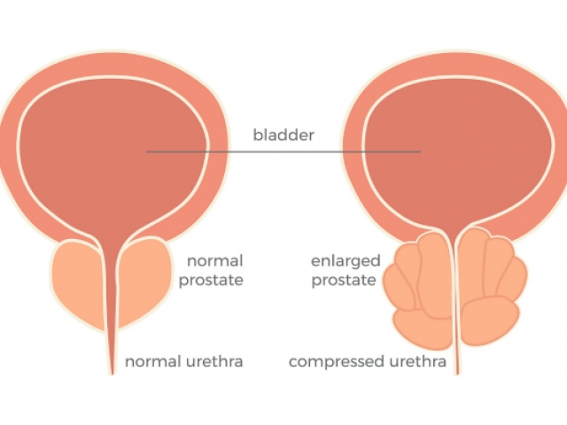 What are some nonsurgical treatments for an enlarged prostate (benign prostatic hyperplasia – BPH)?