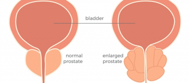 What are some nonsurgical treatments for an enlarged prostate (benign prostatic hyperplasia – BPH)?