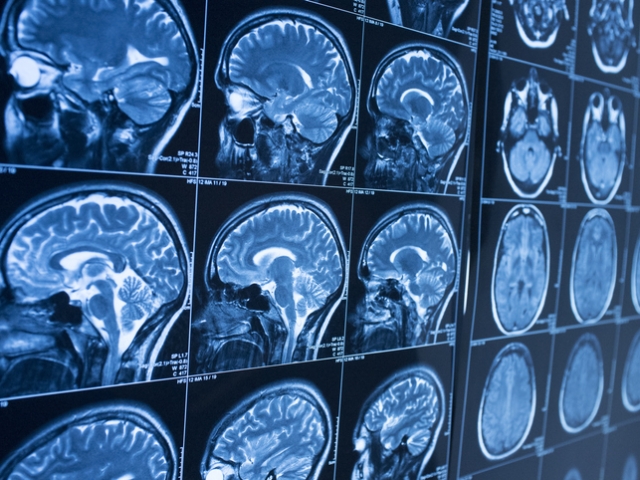 Study Compares Transgender, Cisgender Brain Scans